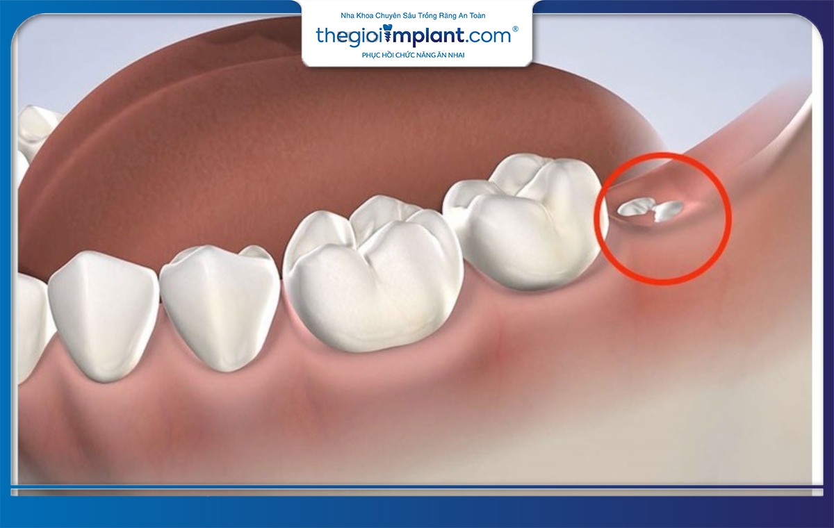 Răng 36 bị sâu quá nặng cần nên nhổ răng