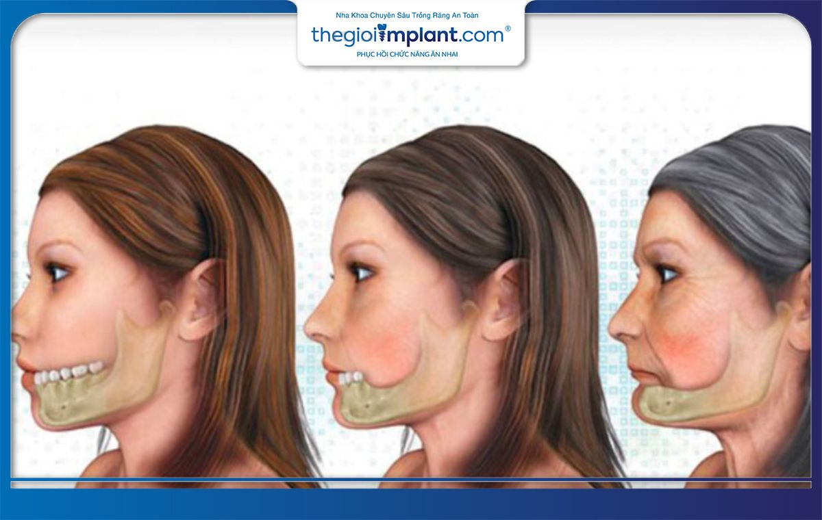 Mất răng 36 lâu dài dẫn đến tình trạng tiêu xương hàm