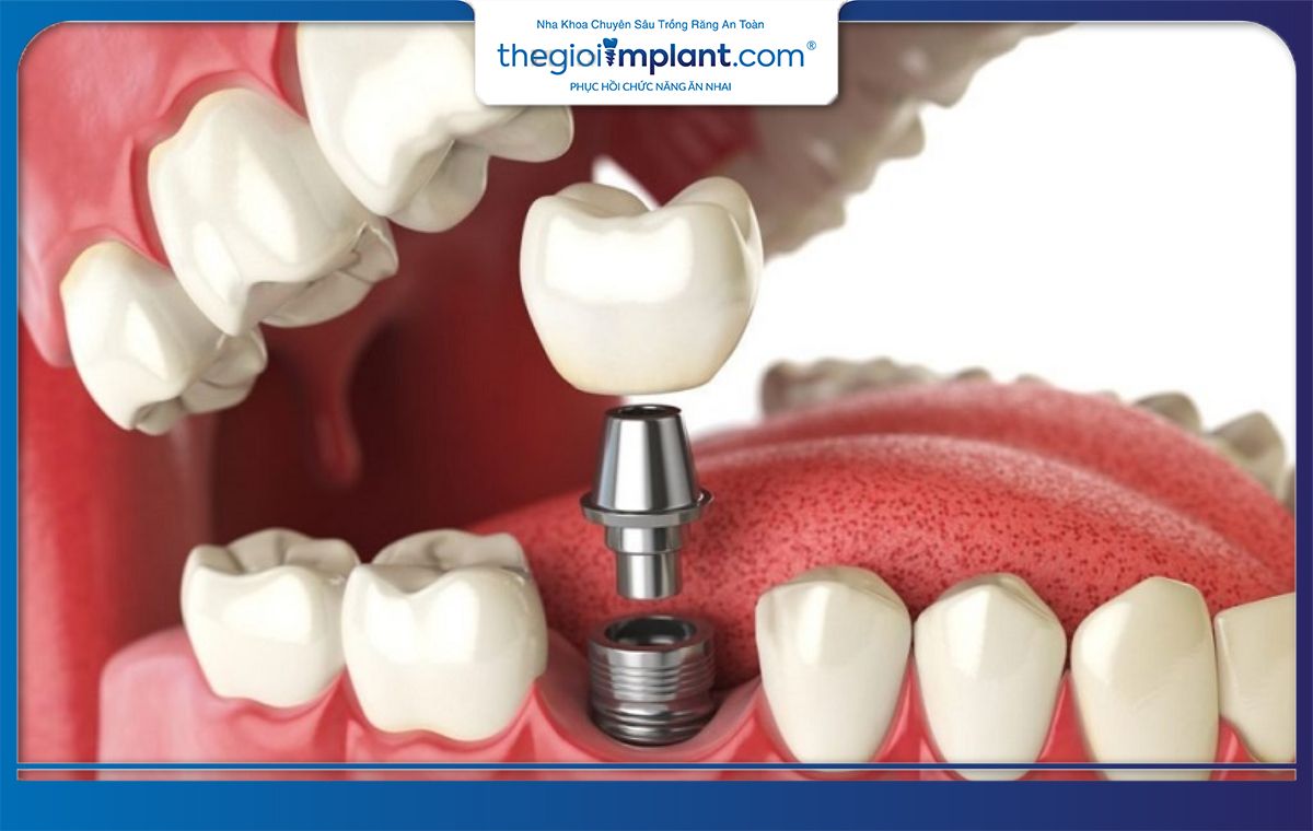 Trồng răng Implant là giải pháp hàng đầu khi bị mất răng 36