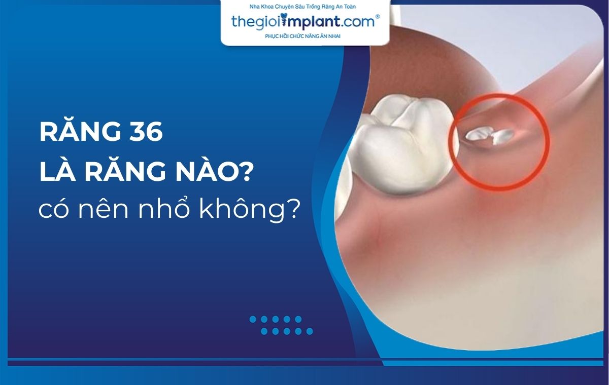 Răng 36 là răng nào? Có nên nhổ không?