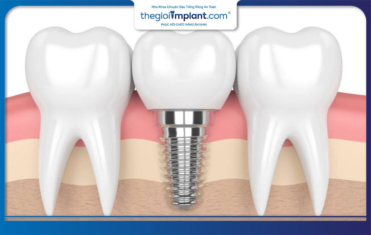 Khoảng từ 2-6 tháng trụ Implant sẽ tích hợp hoàn toàn với xương hàm
