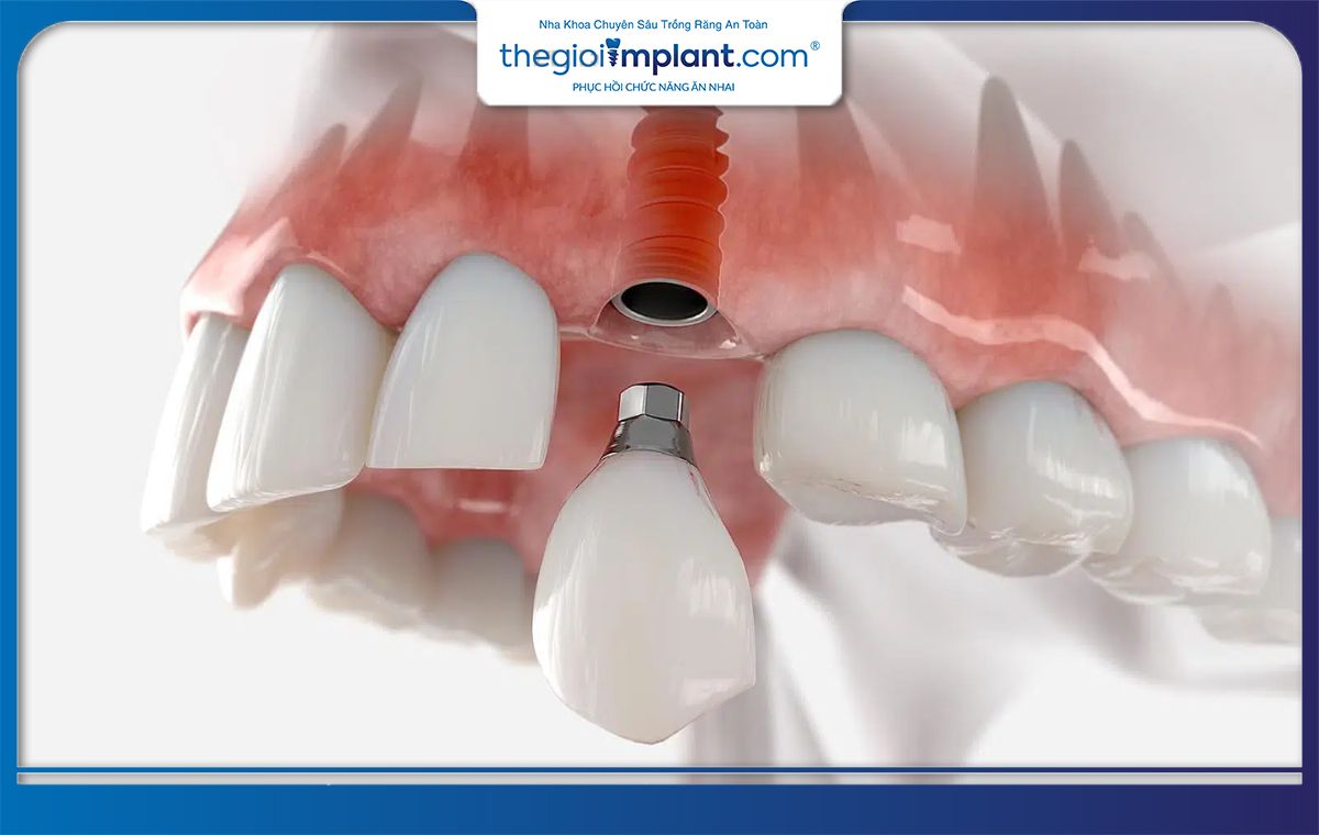 Ăn thức ăn quá cứng hoặc dai có thể làm gãy trụ Implant