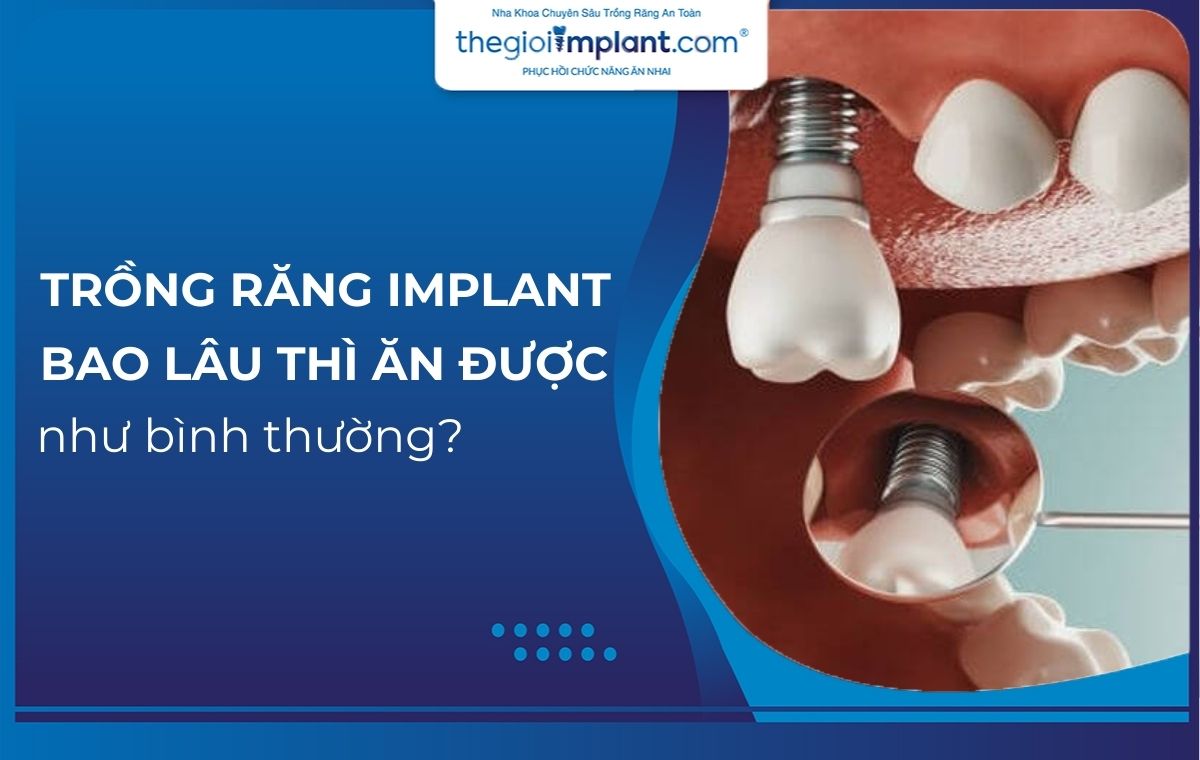 Trồng răng Implant bao lâu thì ăn được như bình thường?
