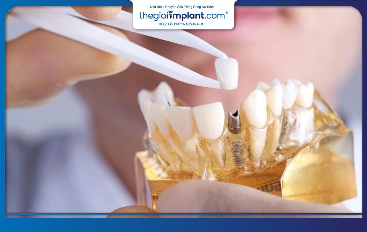 Khi nào bạn không thể chụp CT khi trồng Implant?