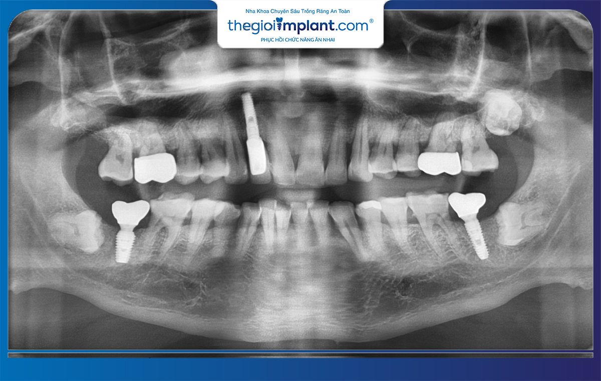 Trồng răng Implant có chụp X quang được không?