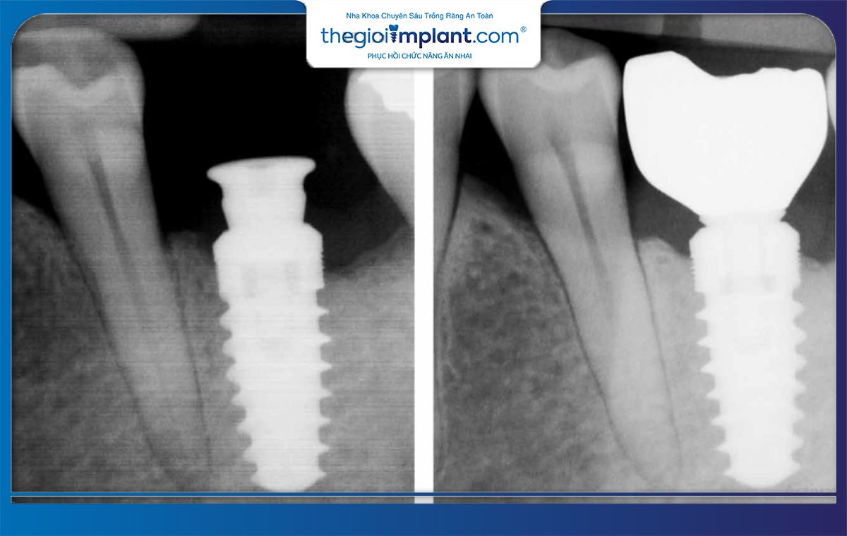 Một số điều cần lưu ý khi muốn chụp X quang sau khi trồng răng Implant