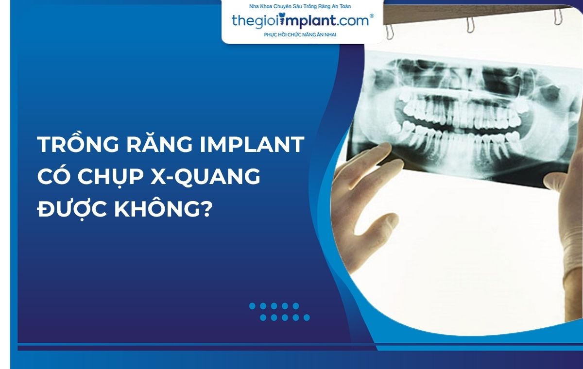 Trồng răng Implant có chụp X quang được không? Vì sao?