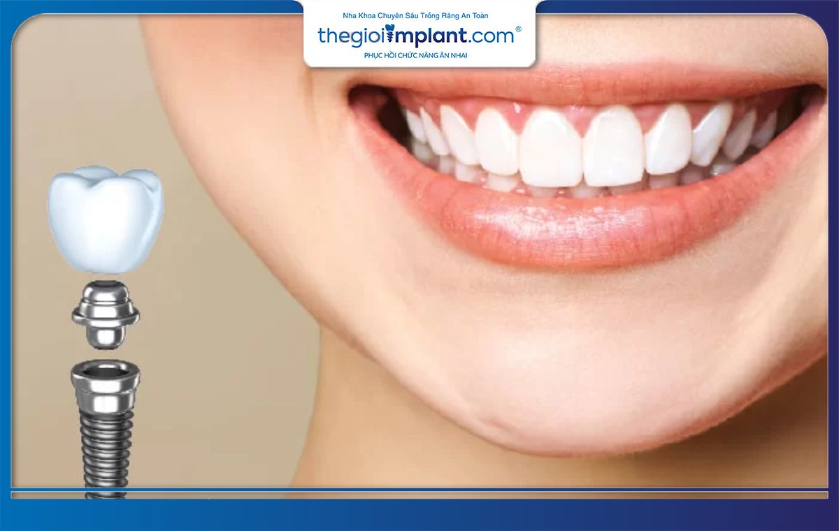 Tìm hiểu về dịch vụ trồng răng Implant trả góp