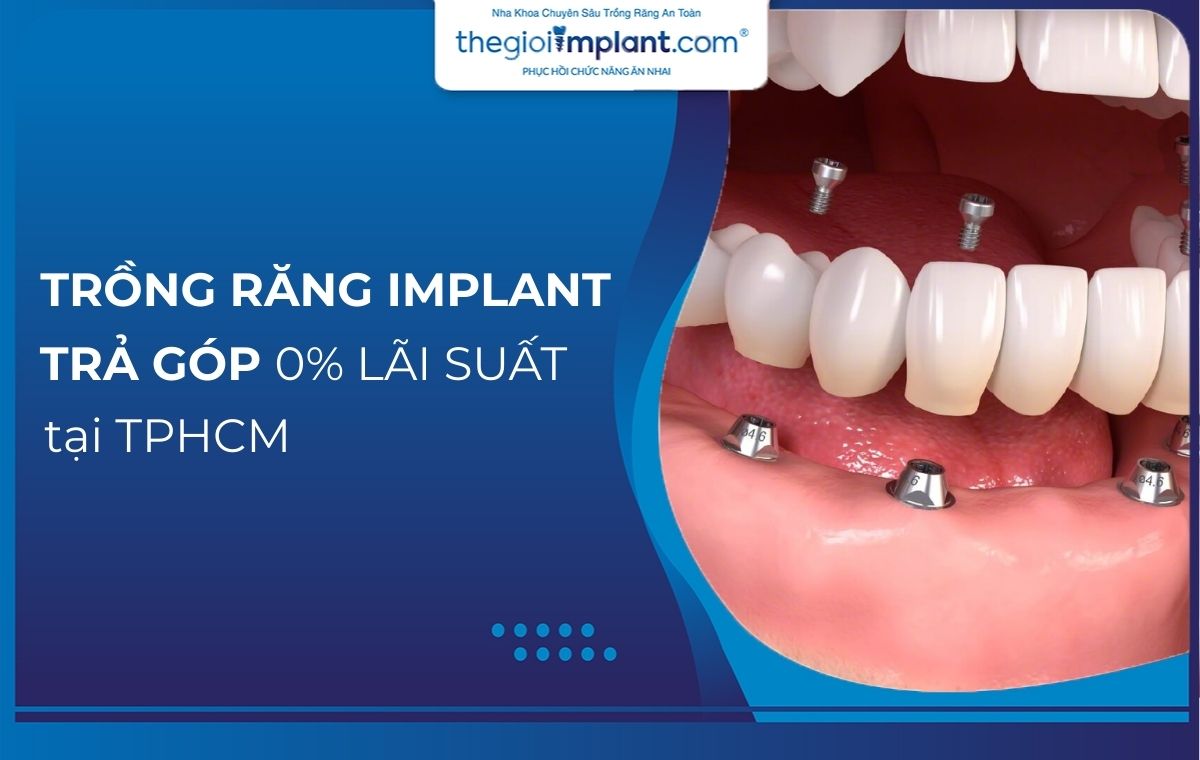 Chính sách trồng răng implant trả góp 0% lãi suất tại TPHCM