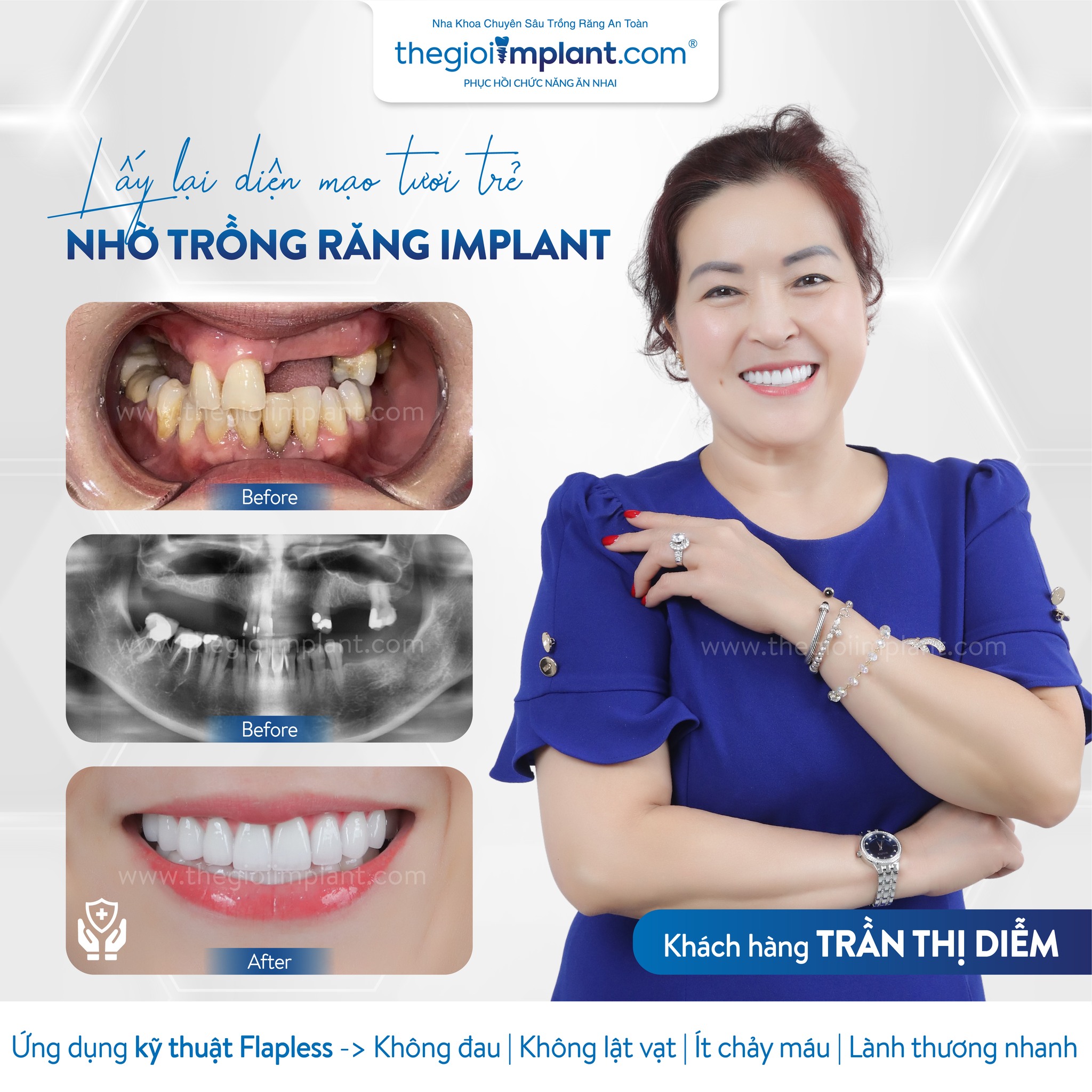 Khách hàng Implant tại Thegioiimplant.com