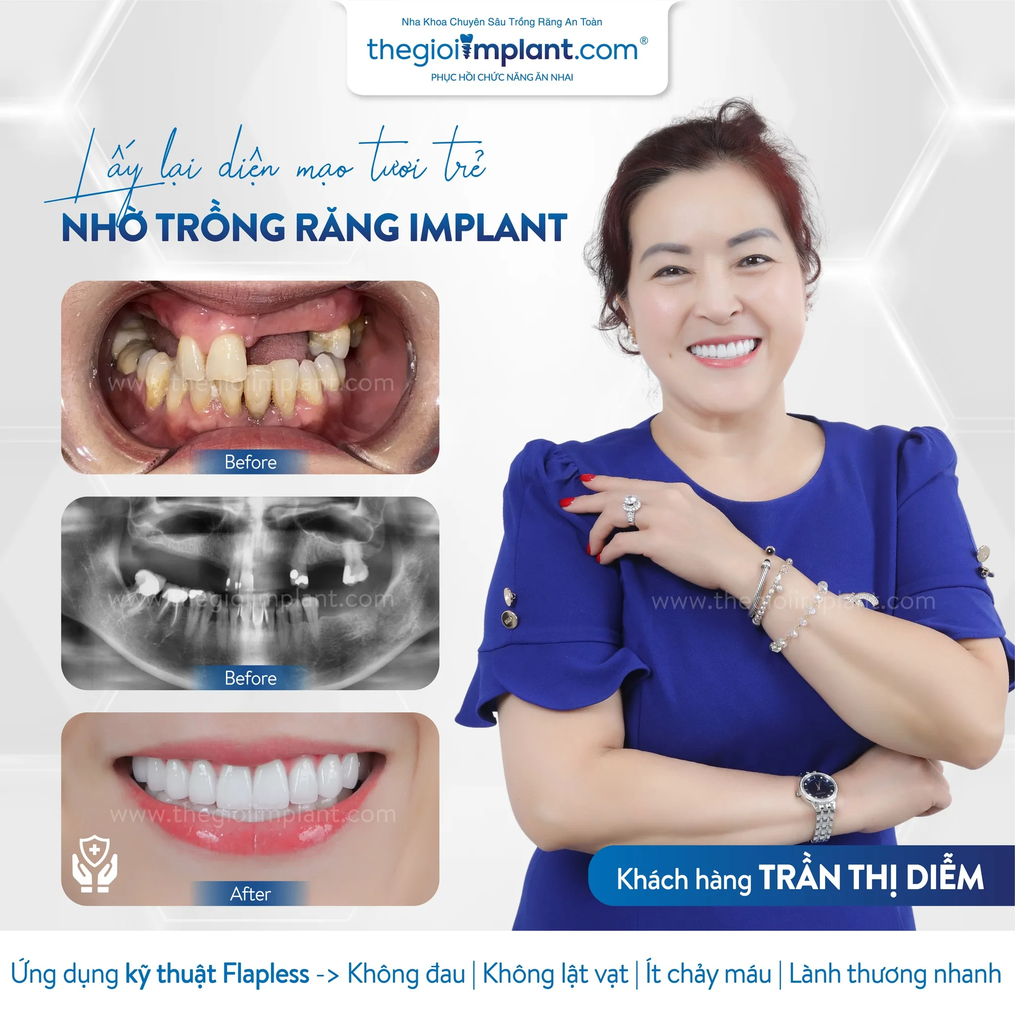 Khách hàng sau ca trồng Implant tại Thegioiimplant.com