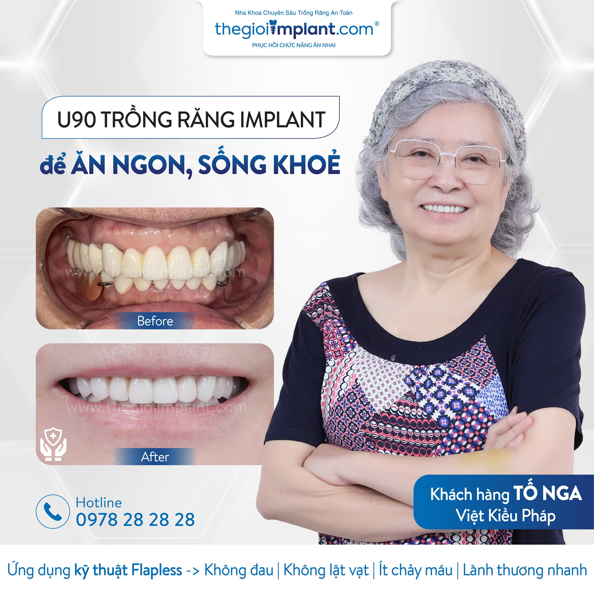 Khách hàng Implant tại Thegioiimplant.com
