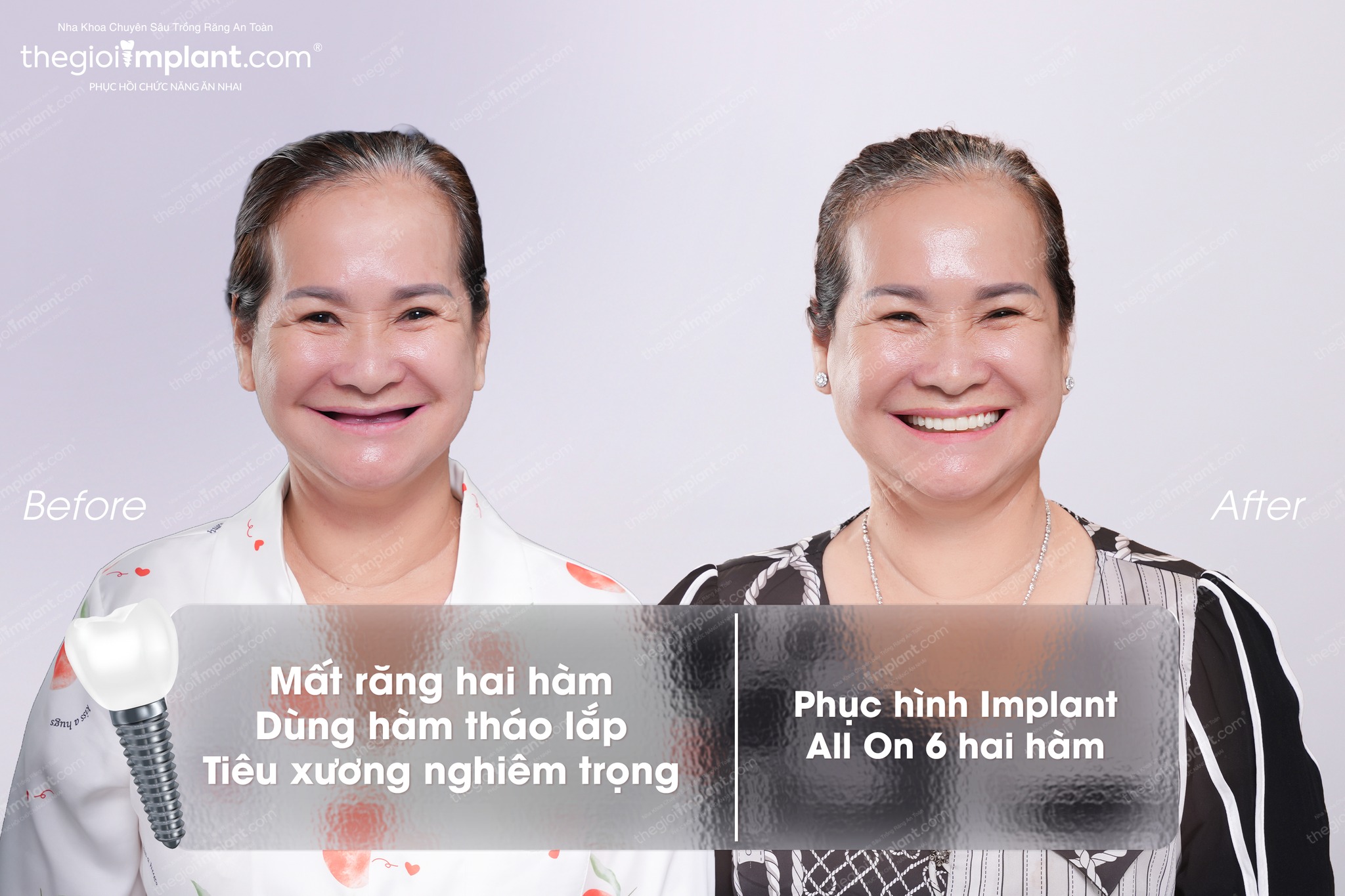 Cô khách hàng lớn tuổi sau ca Implant cùng BS Võ Tá Dũng