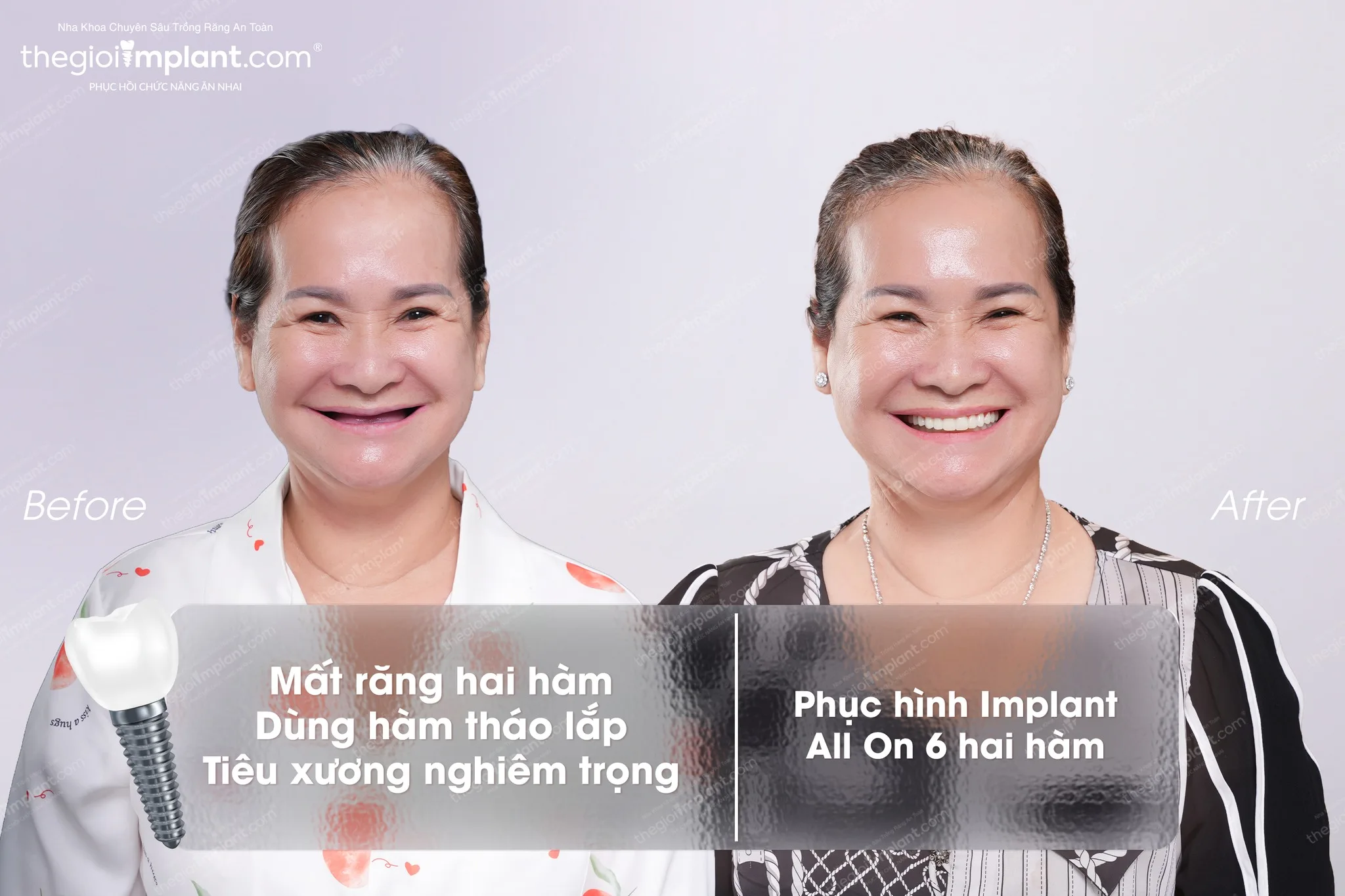 Khách hàng lớn tuổi sau ca Implant tại Thegioiimplant.com