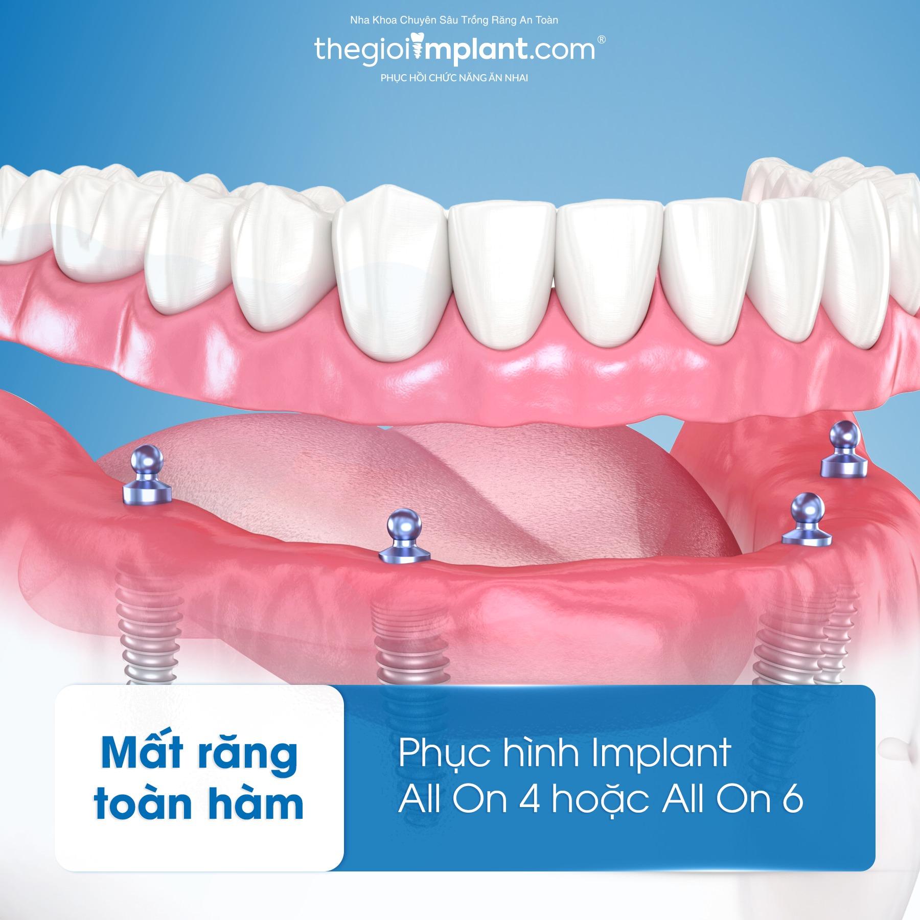 all on 4 implant