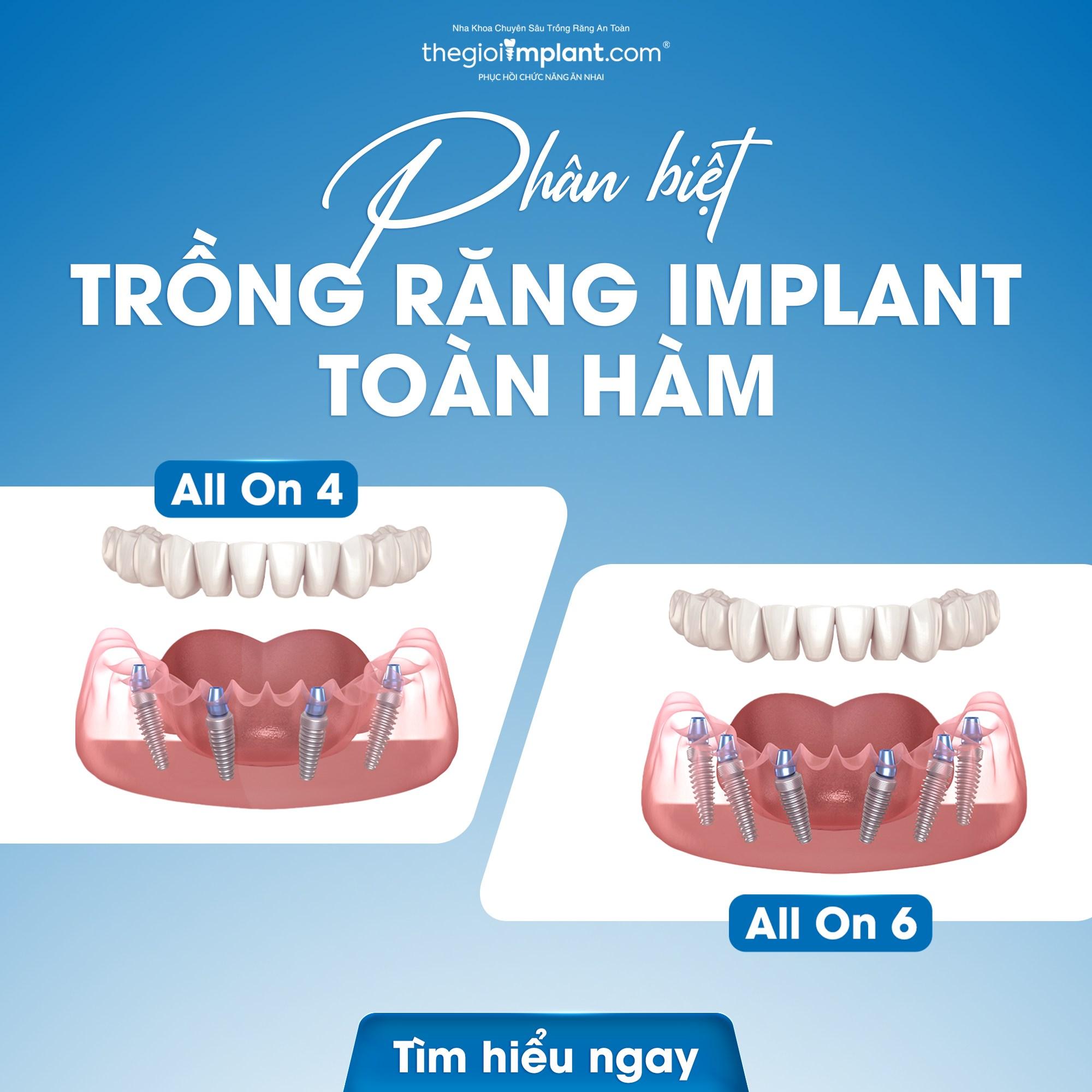 all on 4 implant - hình 2