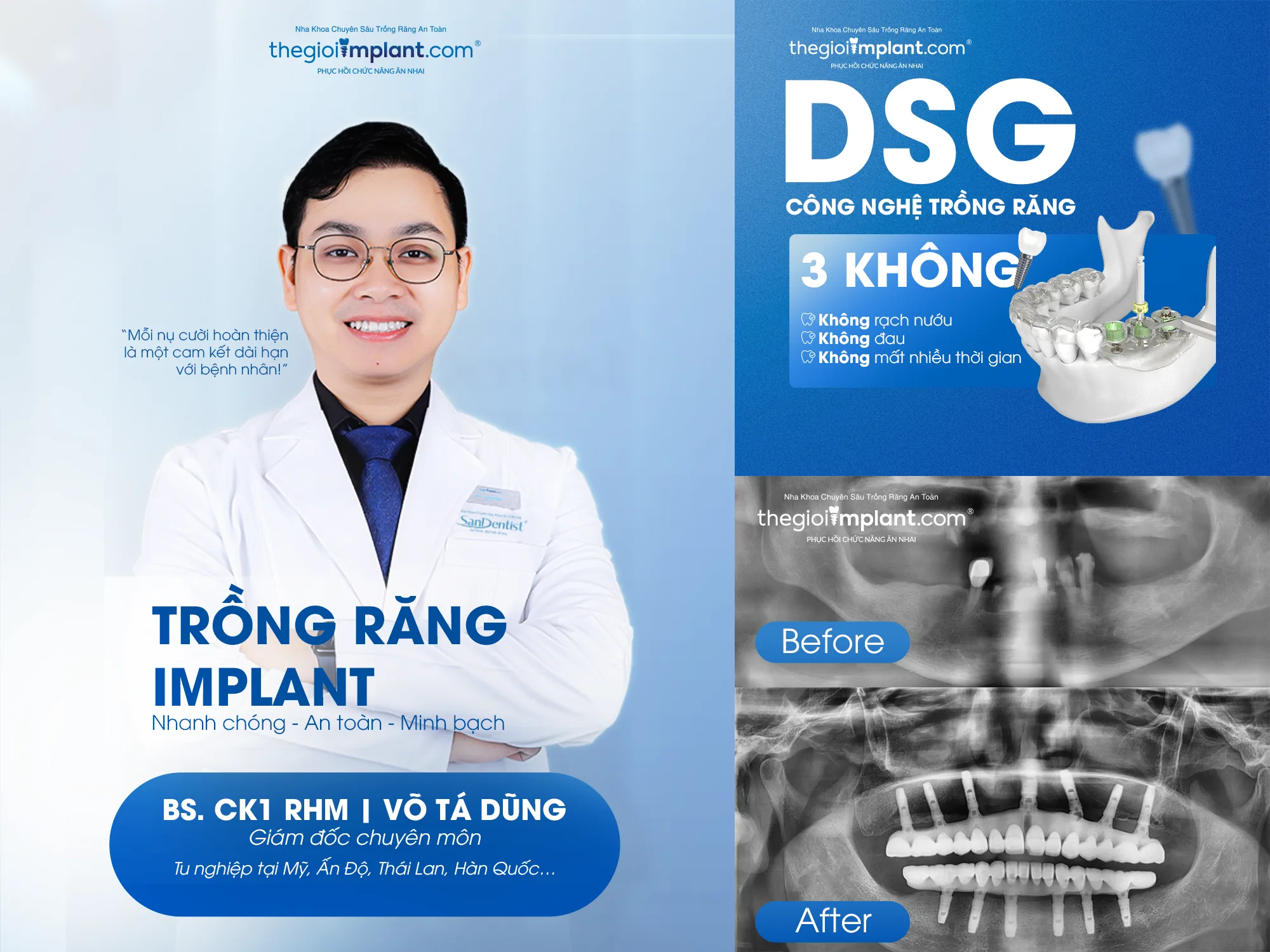 all on 4 implant - hình 3