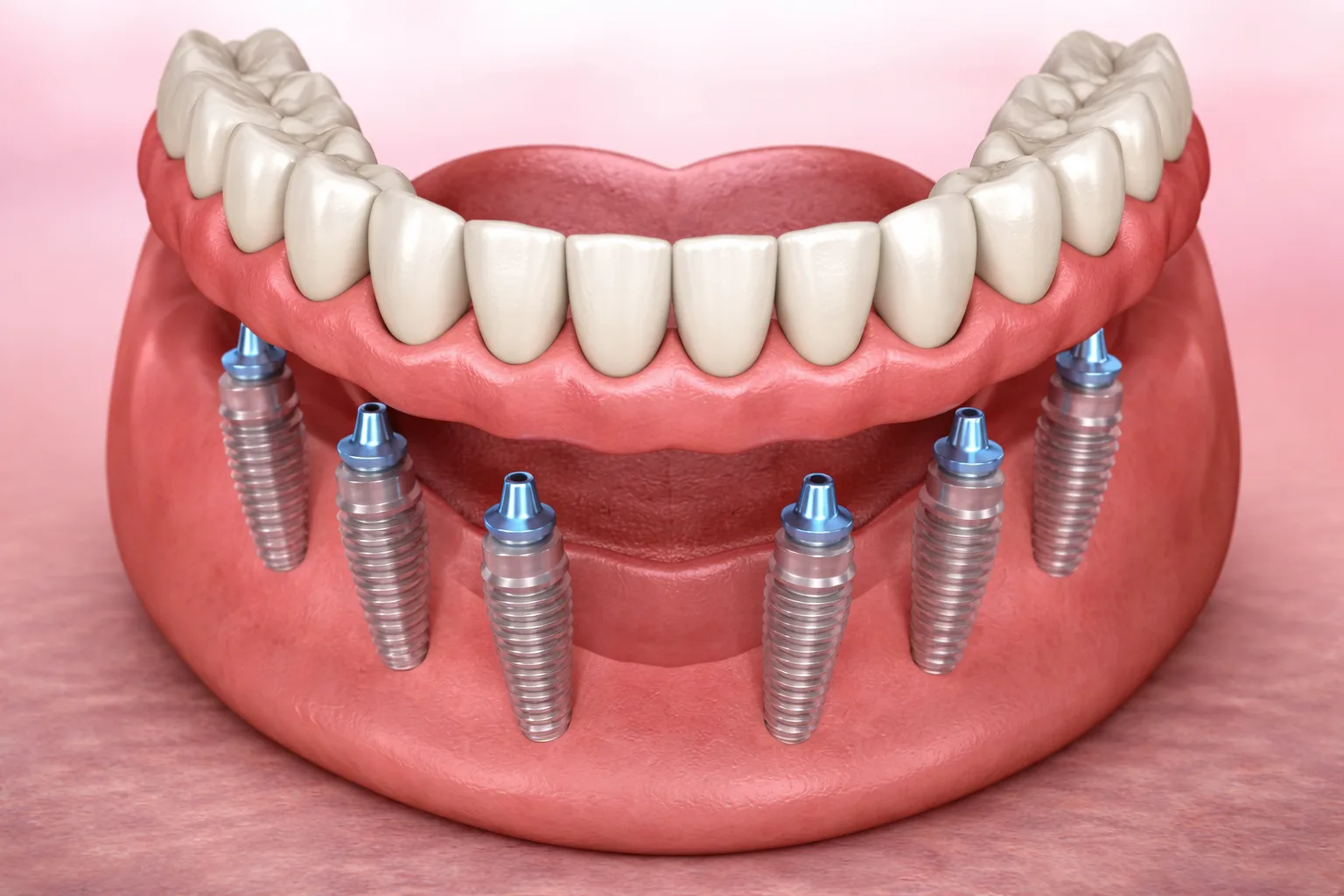 all on 6 implant