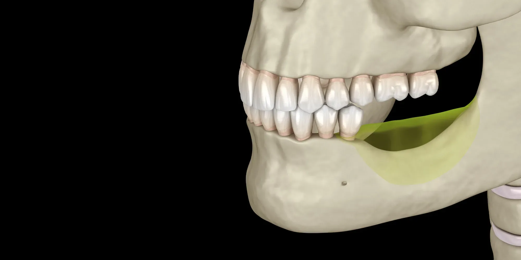 ghép xương implant - hình 2