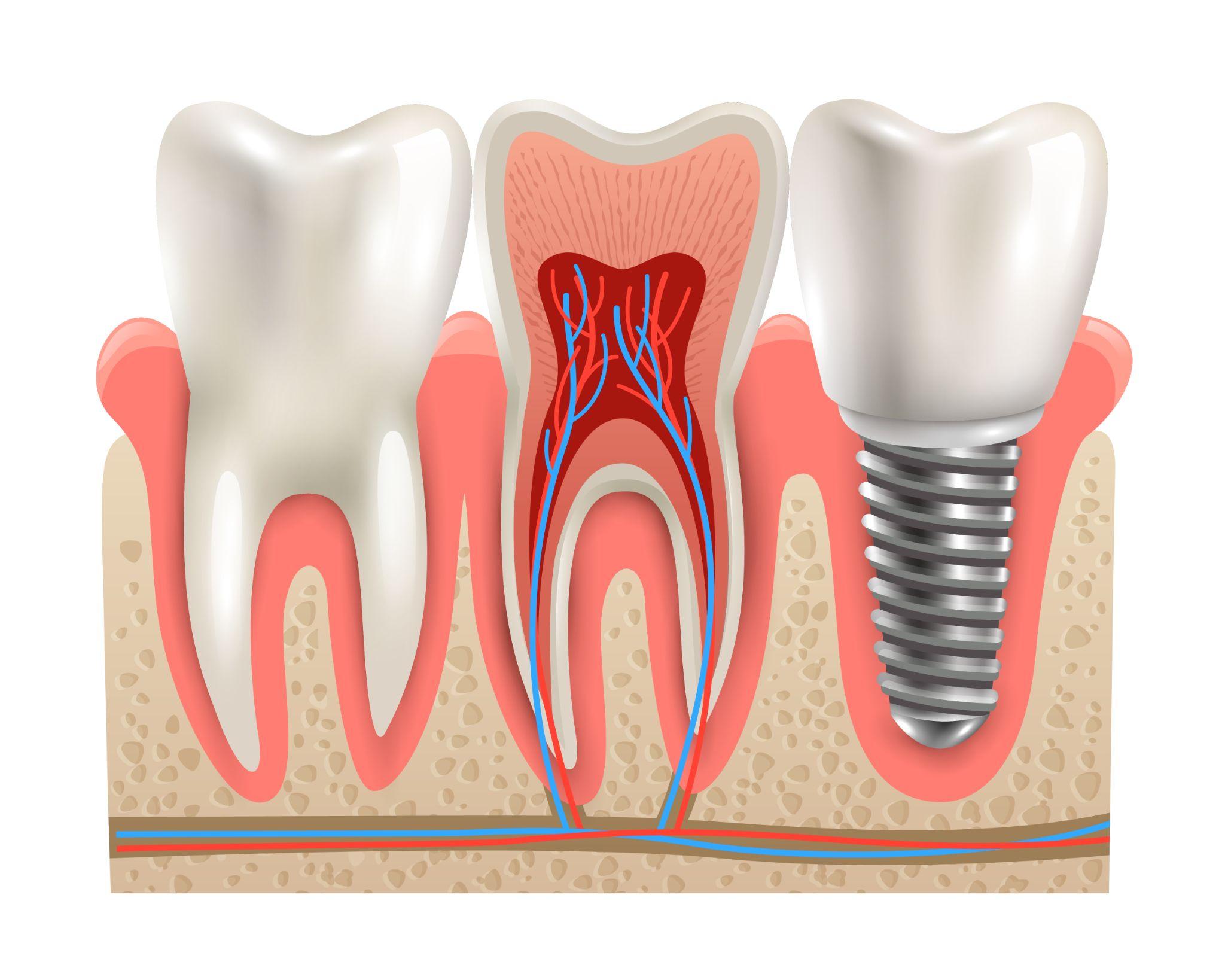 Implant Osstem: Đánh giá, giá và ưu nhược điểm 2026