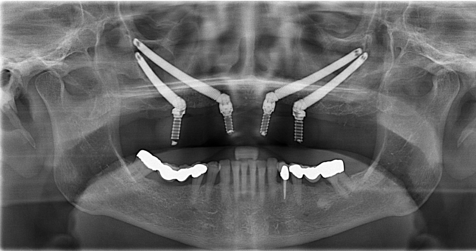 implant zygoma - hình 2