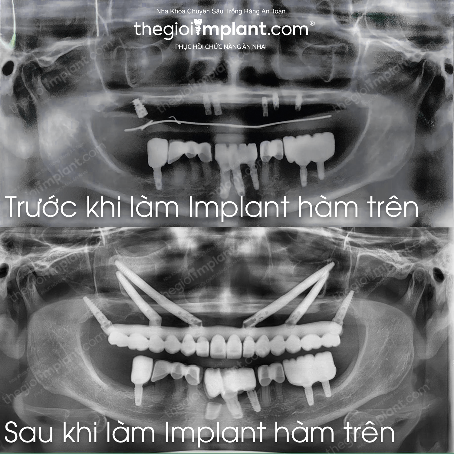 implant zygoma - hình 3