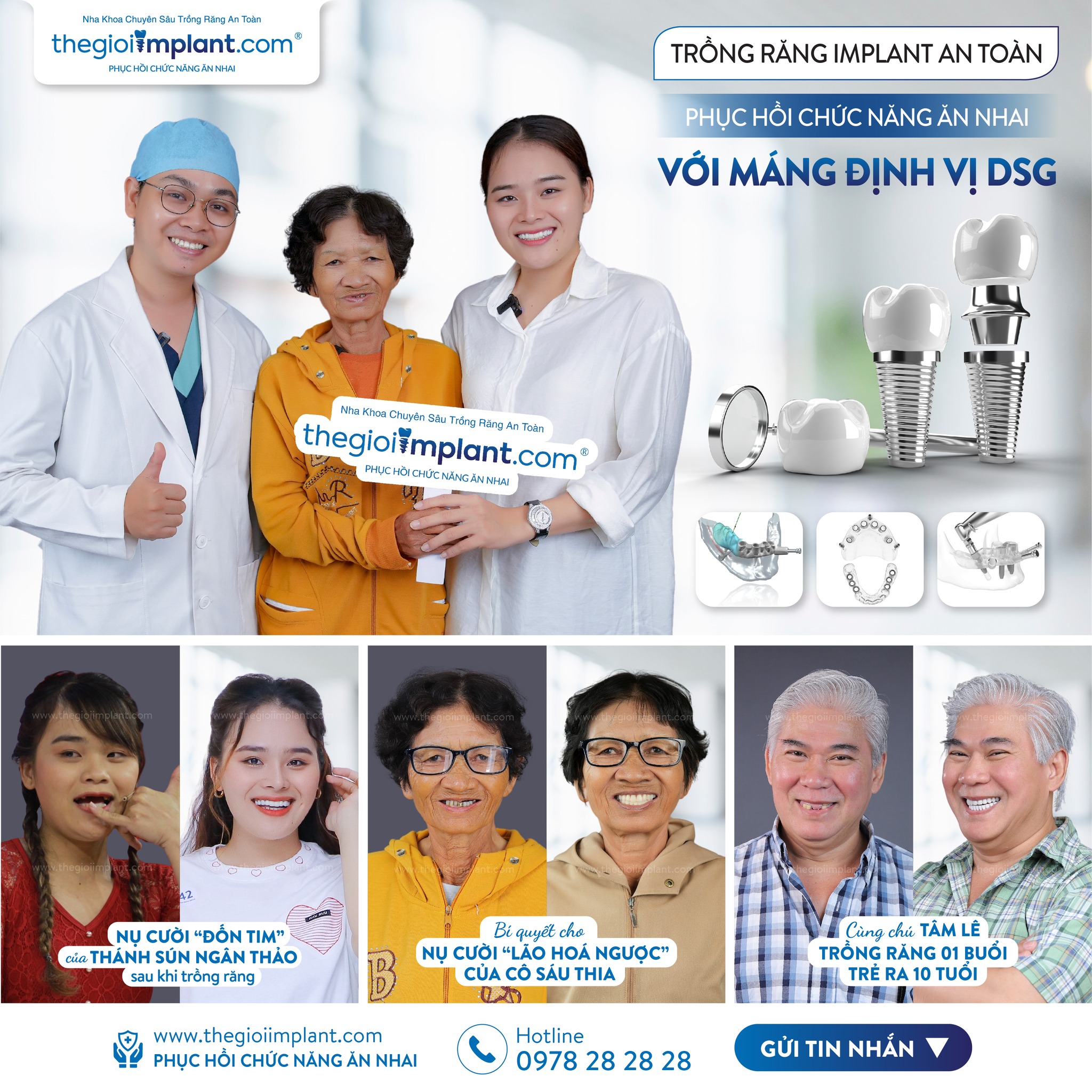 All on 6 Implant: So sánh với All on 4 và bảng giá 2026