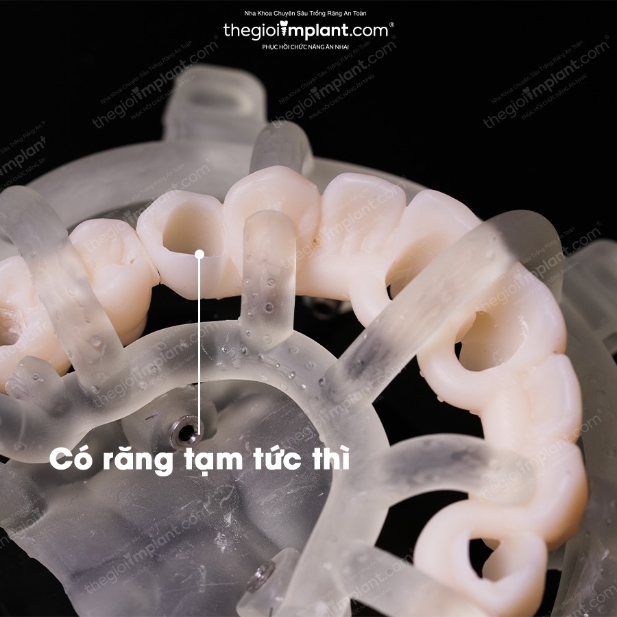 Cấy ghép 5 phút mỗi trụ