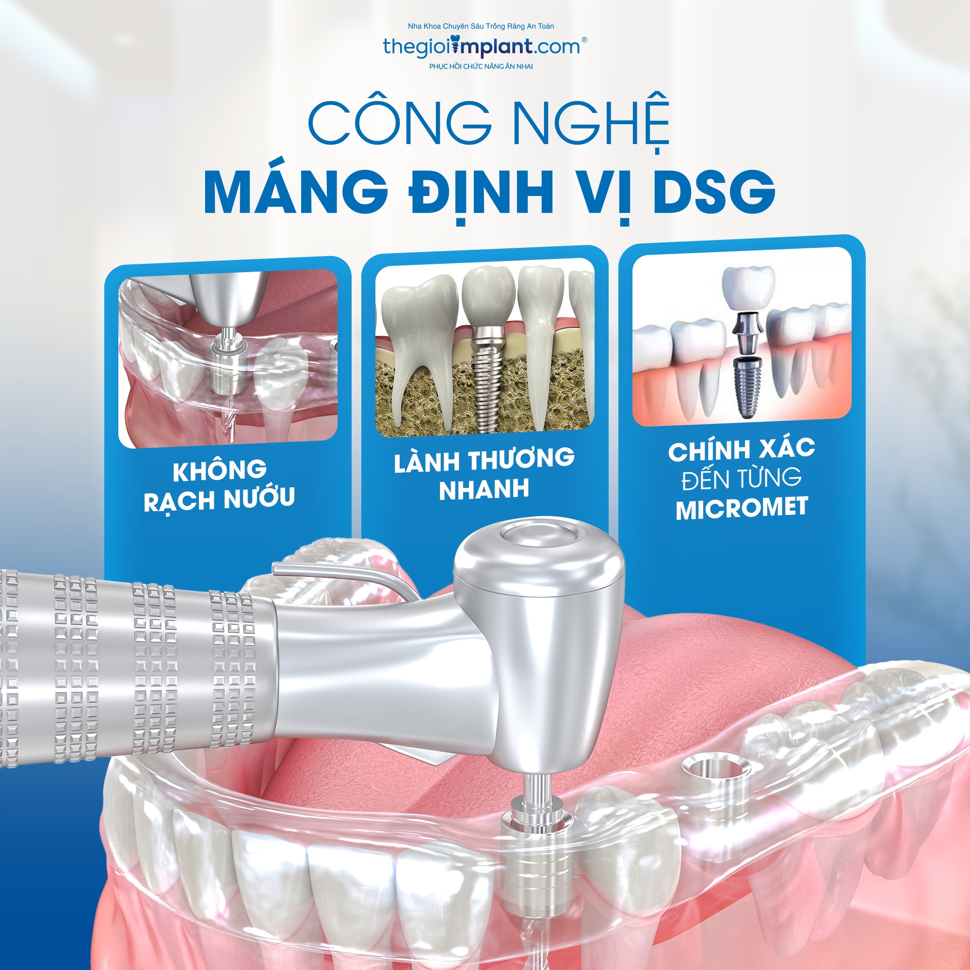 All on 4 Implant: Chi phí, quy trình và ai phù hợp 2026