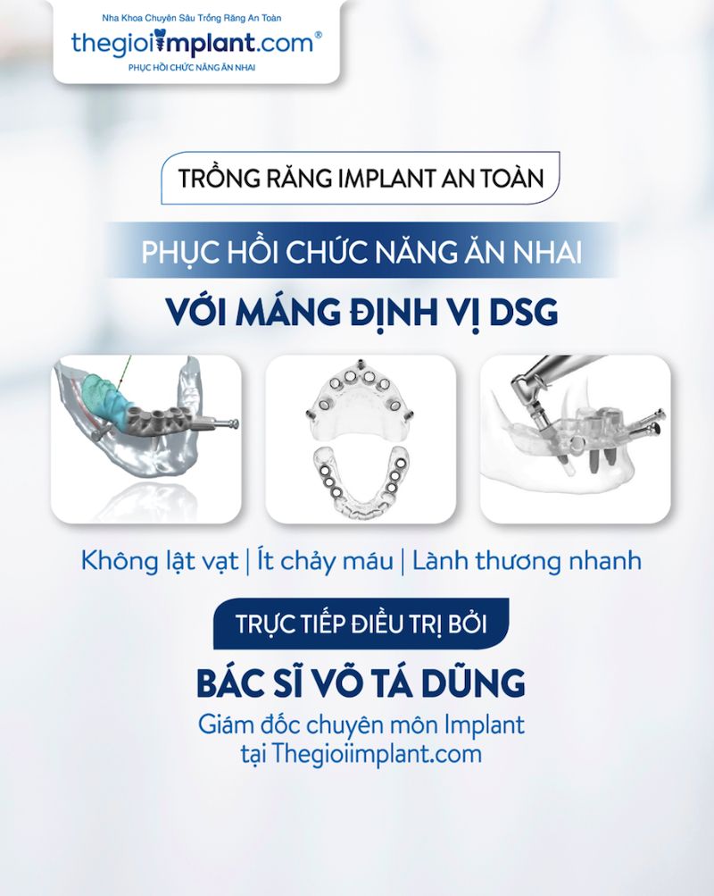 Máng định vị DSG. Công nghệ chuẩn quốc tế cho Implant hiện đại tại Thegioiimplant.com