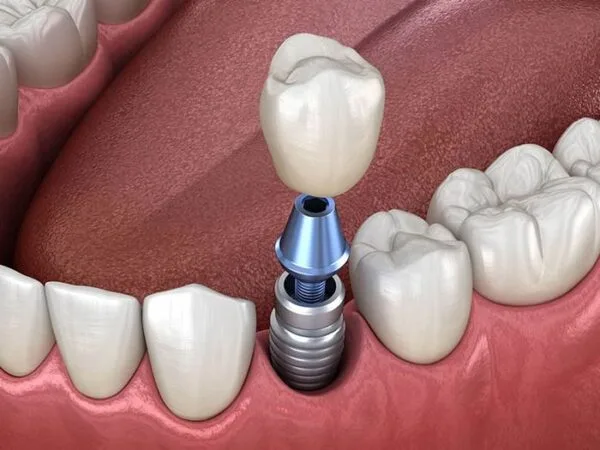 implant có đau không - hình 3