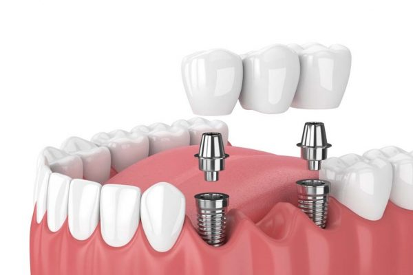 Bảng giá trồng răng Implant 2026: Chi phí trọn gói theo từng hãng trụ