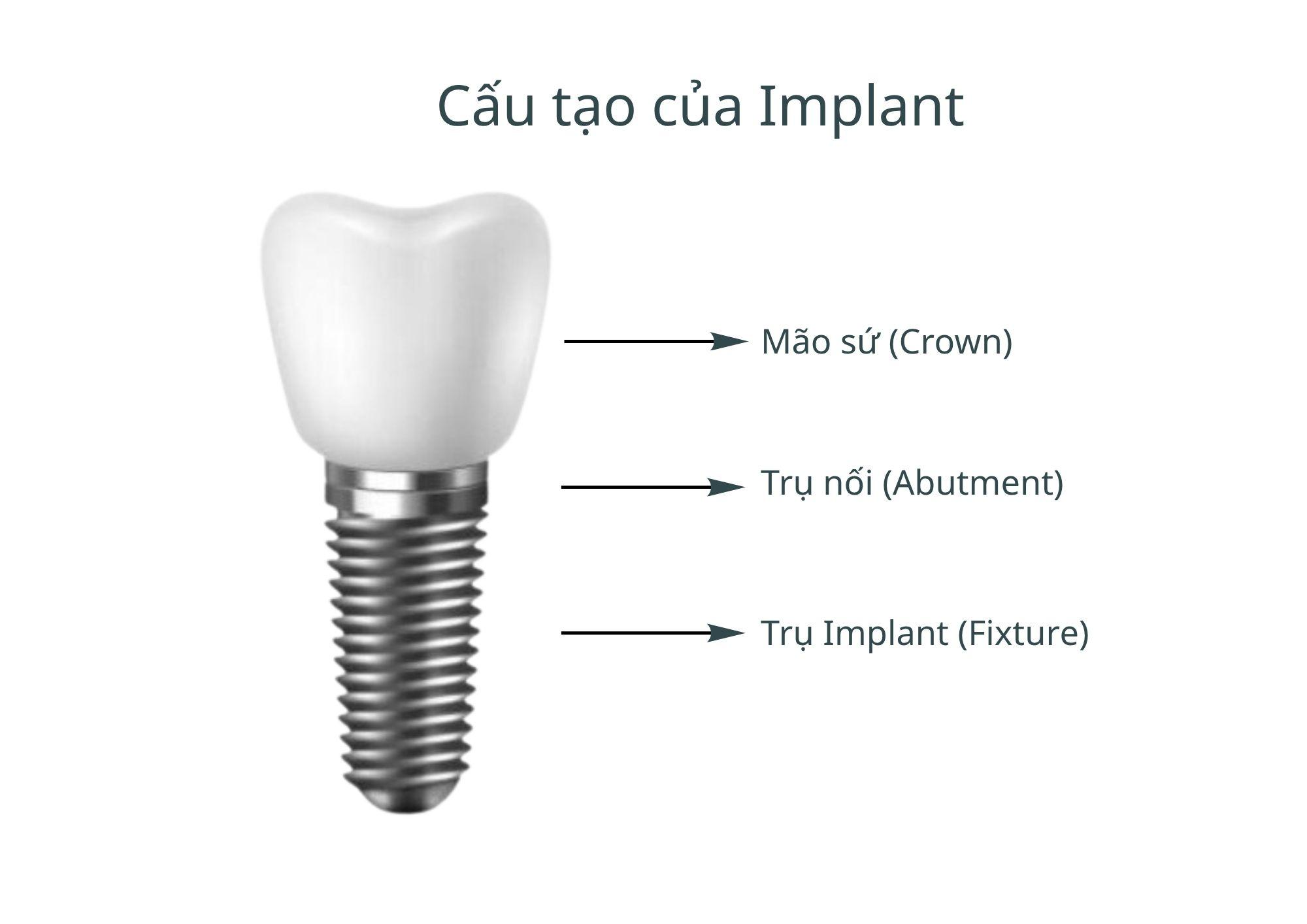 Trồng răng Implant là gì? Toàn bộ kiến thức từ A-Z cho người mới tìm hiểu
