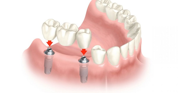 Trồng răng Implant là gì? Toàn bộ kiến thức từ A-Z cho người mới tìm hiểu