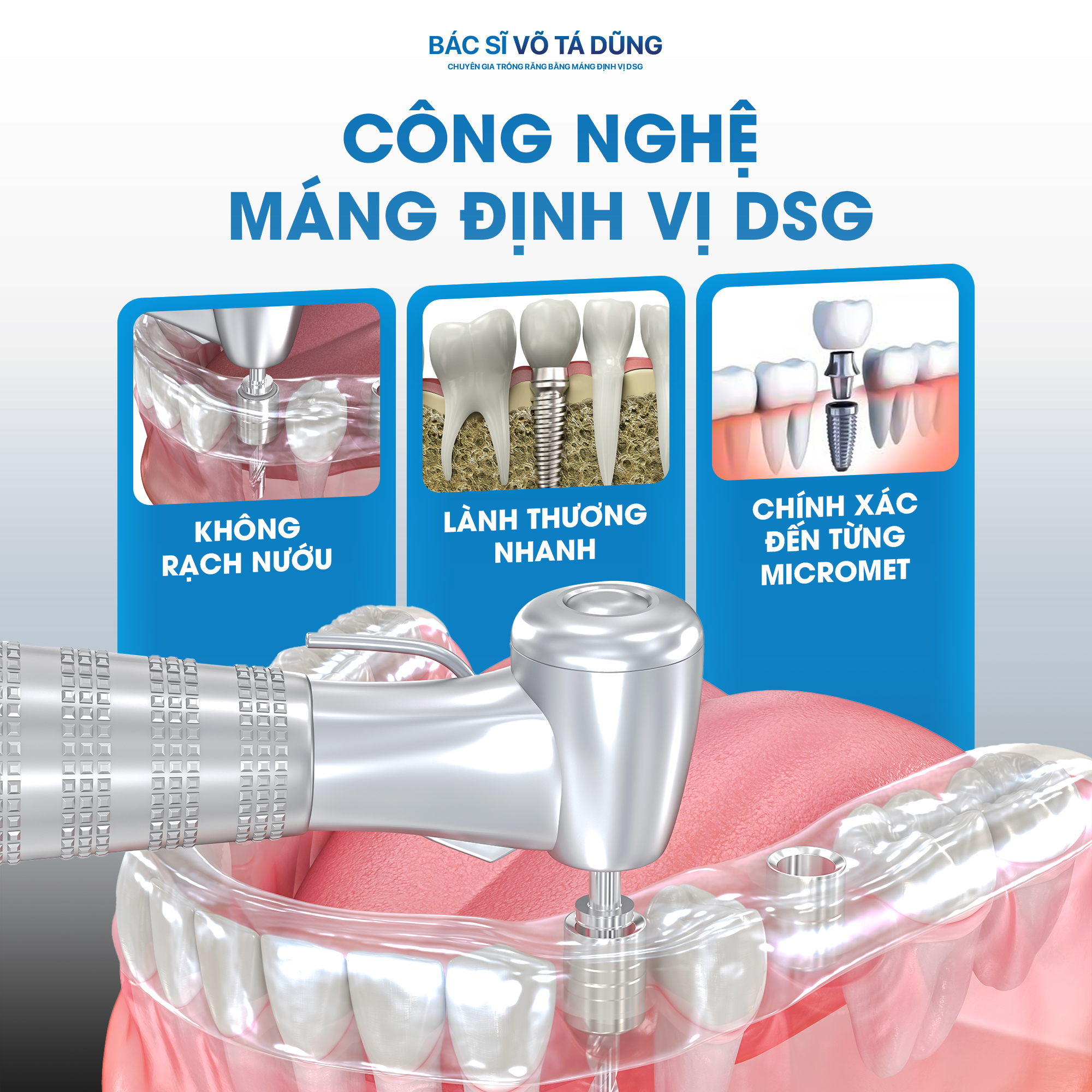 Công nghệ máng định vị DSG - không rạch nướu, lành thương nhanh, chính xác từng micromet