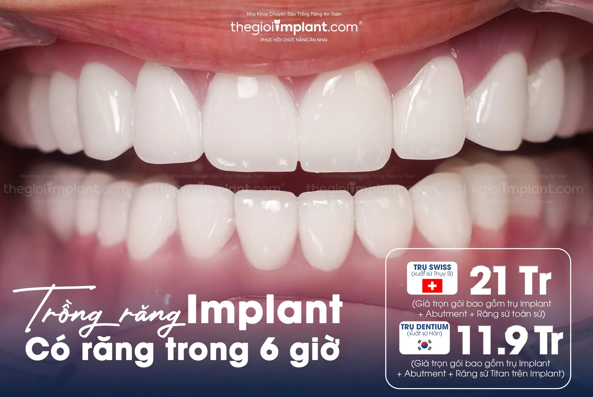 chi phí trồng răng implant - hình 2