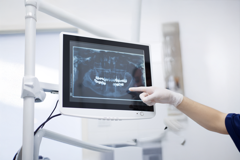 Cone Beam CT 3D trong cấy Implant: vai trò chẩn đoán xương hàm 2026