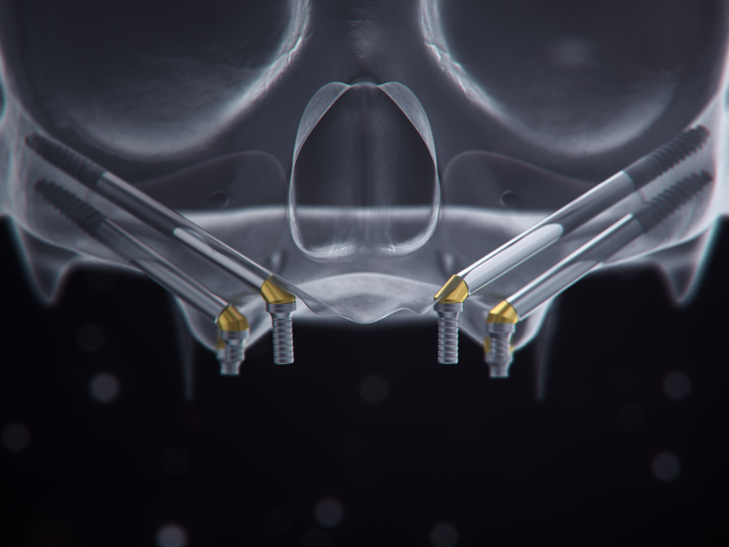 implant chân bướm - hình 2