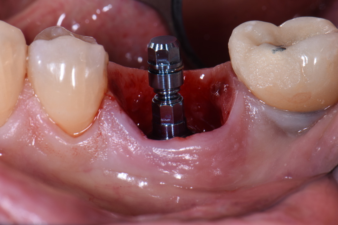 implant tức thì - hình 2