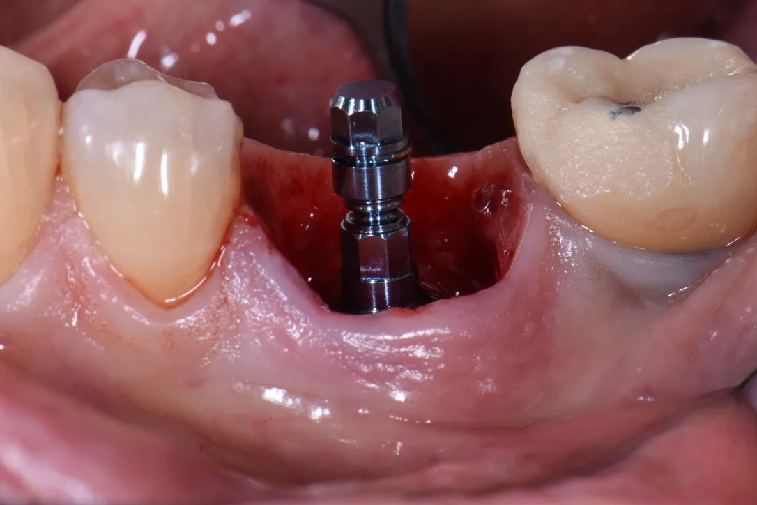 implant tức thì - hình 2