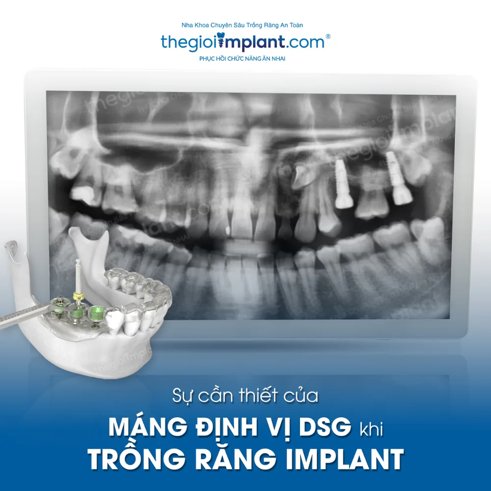 máng định vị dsg - hình 5