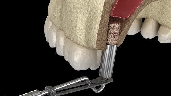 Nâng xoang hàm Implant: Quy trình và chi phí chi tiết 2026