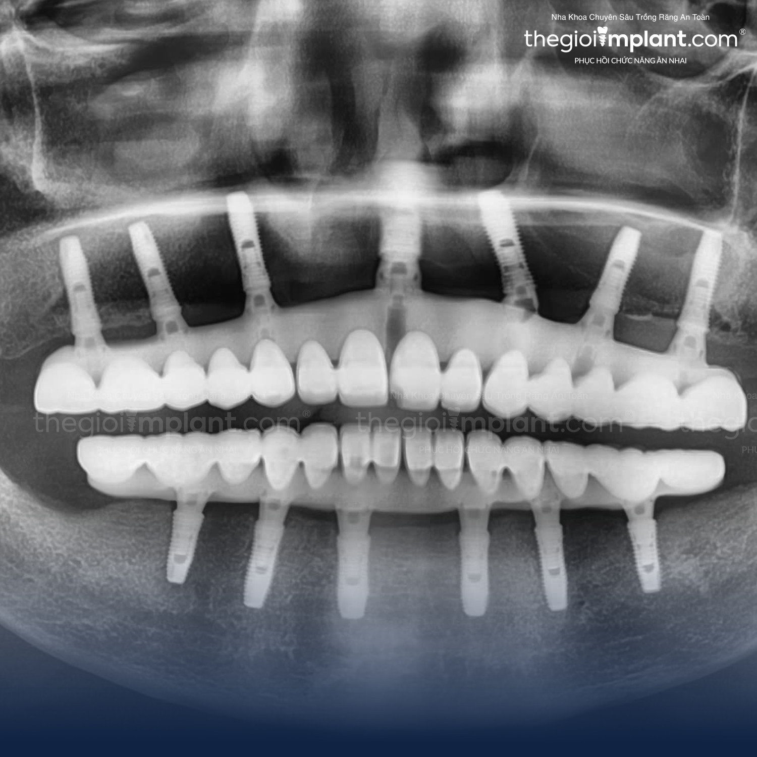 quy trình trồng răng implant - hình 2