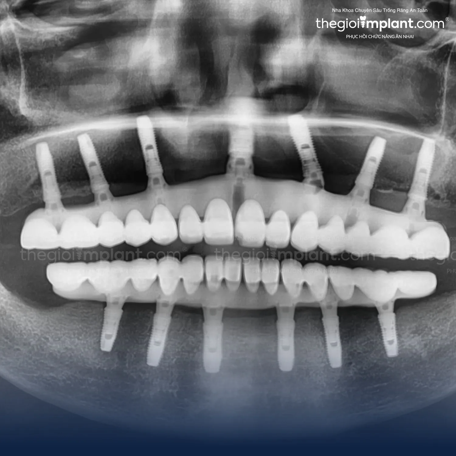 quy trình trồng răng implant - hình 2