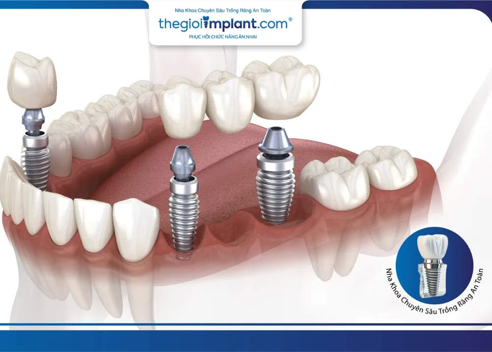 quy trình trồng răng implant - hình 3