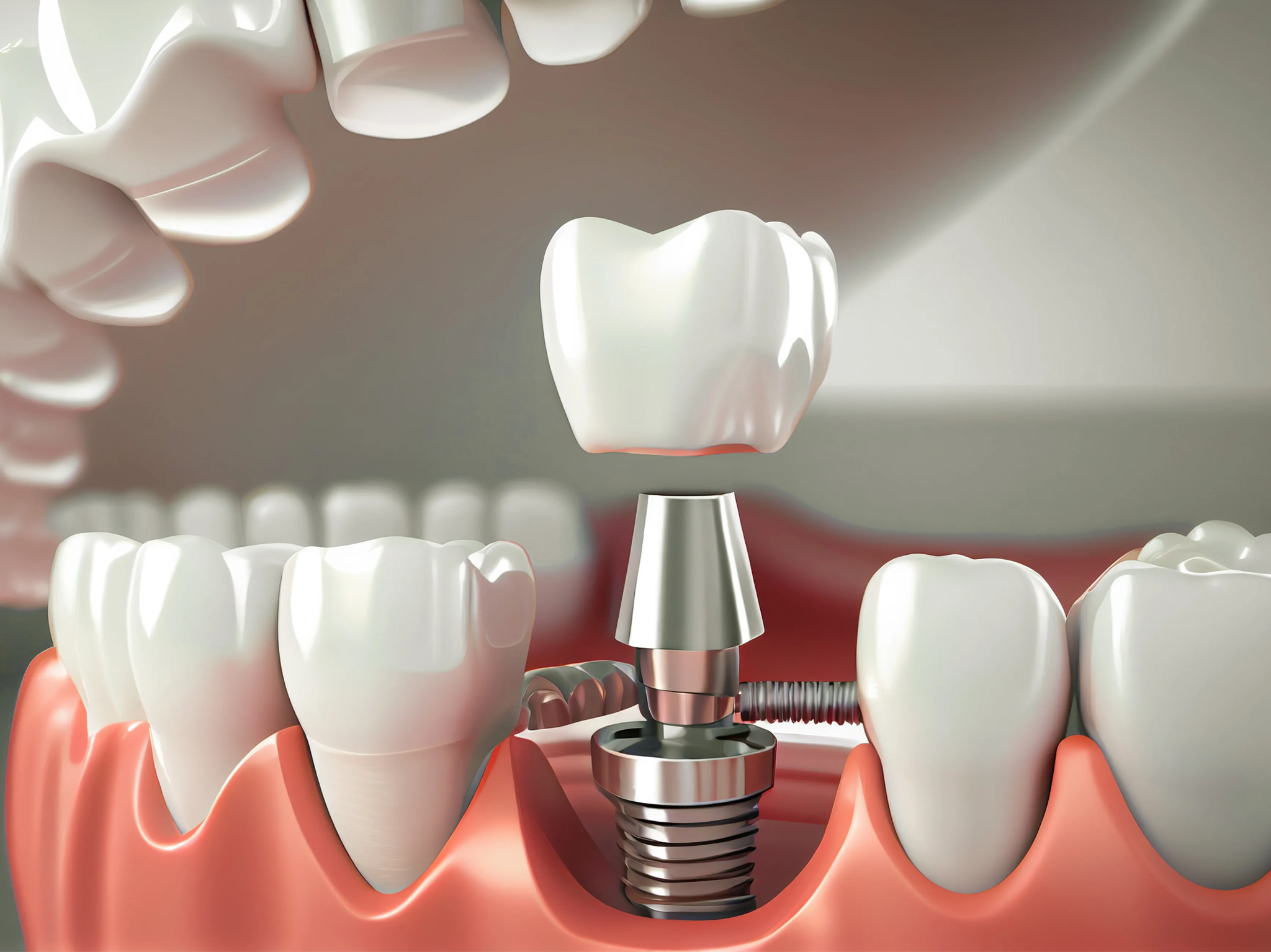 Trồng răng Implant Dentium 11.9 triệu có tốt không? Đánh giá 2026