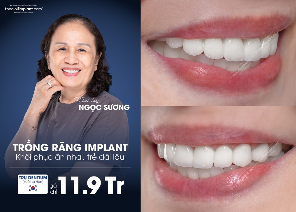 răng implant dentium - hình 2