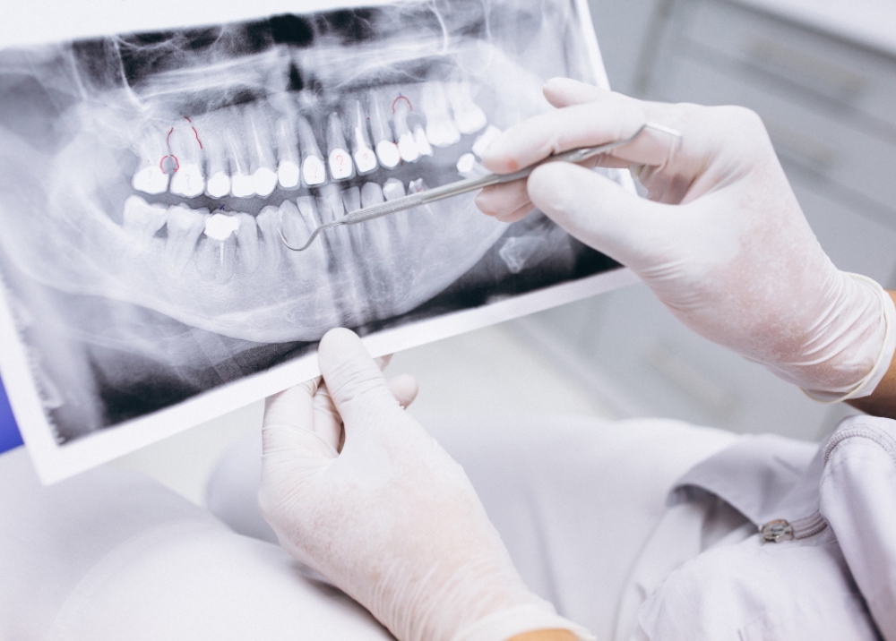 răng implant dentium - hình 4