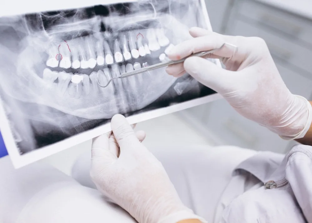 răng implant dentium - hình 4