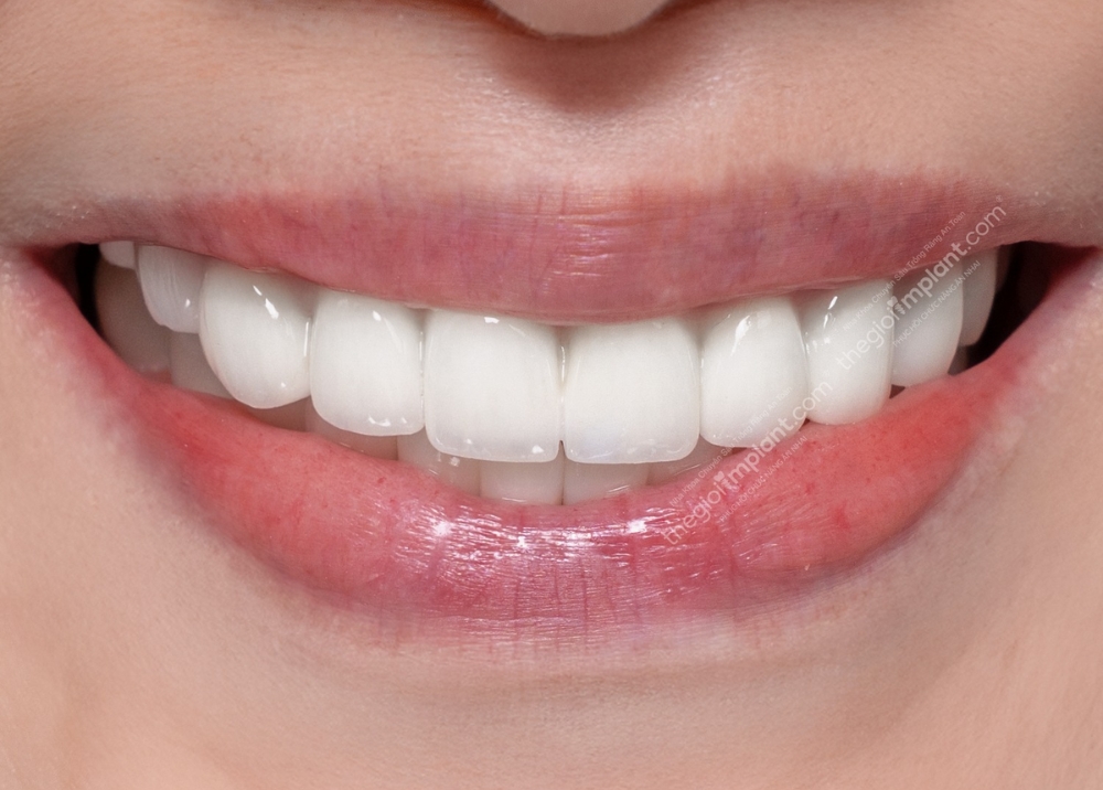 răng implant dentium - hình 5